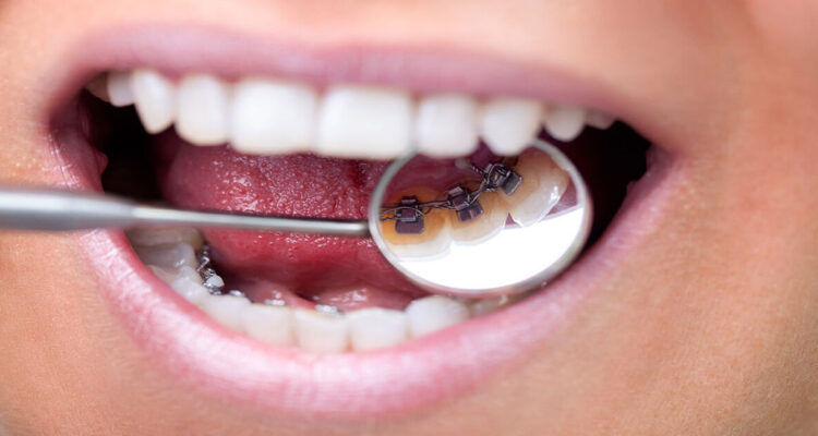 Lingual Ortodonti Tedavisi